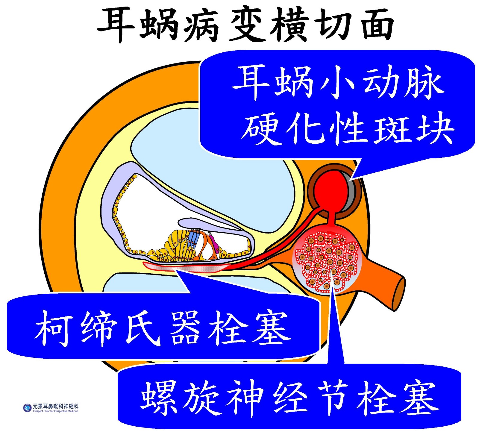 類風濕性關節炎伴生性耳鳴症候群 圖三 (大陸).jpg