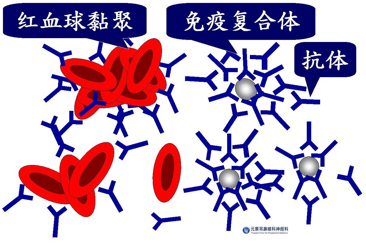 類風濕性關節炎伴生性耳鳴症候群 圖二 (大陸).jpg